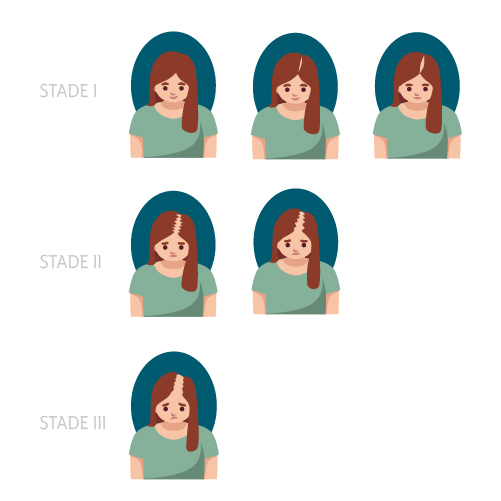 Echelle de Ludwig, évolution de la perte de cheveux, la calvitie, de l'alopécie chez les femmes. Le cabinet Arkéderm de tricopigmentation est situé à Annecy à proximité de Genève, Chamonix, Aix-les-bains, chambéry, grenoble, Lyon. on crée l'illusion de faux cheveux, comme si le follicule pileux repoussait.