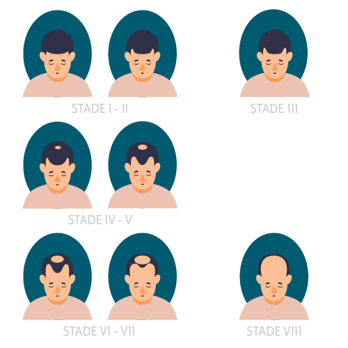Echelle de Norwood, évolution de la perte de cheveux, la calvitie, de l'alopécie chez les hommes. Le cabinet Arkéderm de tricopigmentation est situé à Annecy à proximité de Genève, Chamonix, Aix-les-bains, chambéry, grenoble, Lyon. on crée l'illusion de faux cheveux, comme si le follicule pileux repoussait.