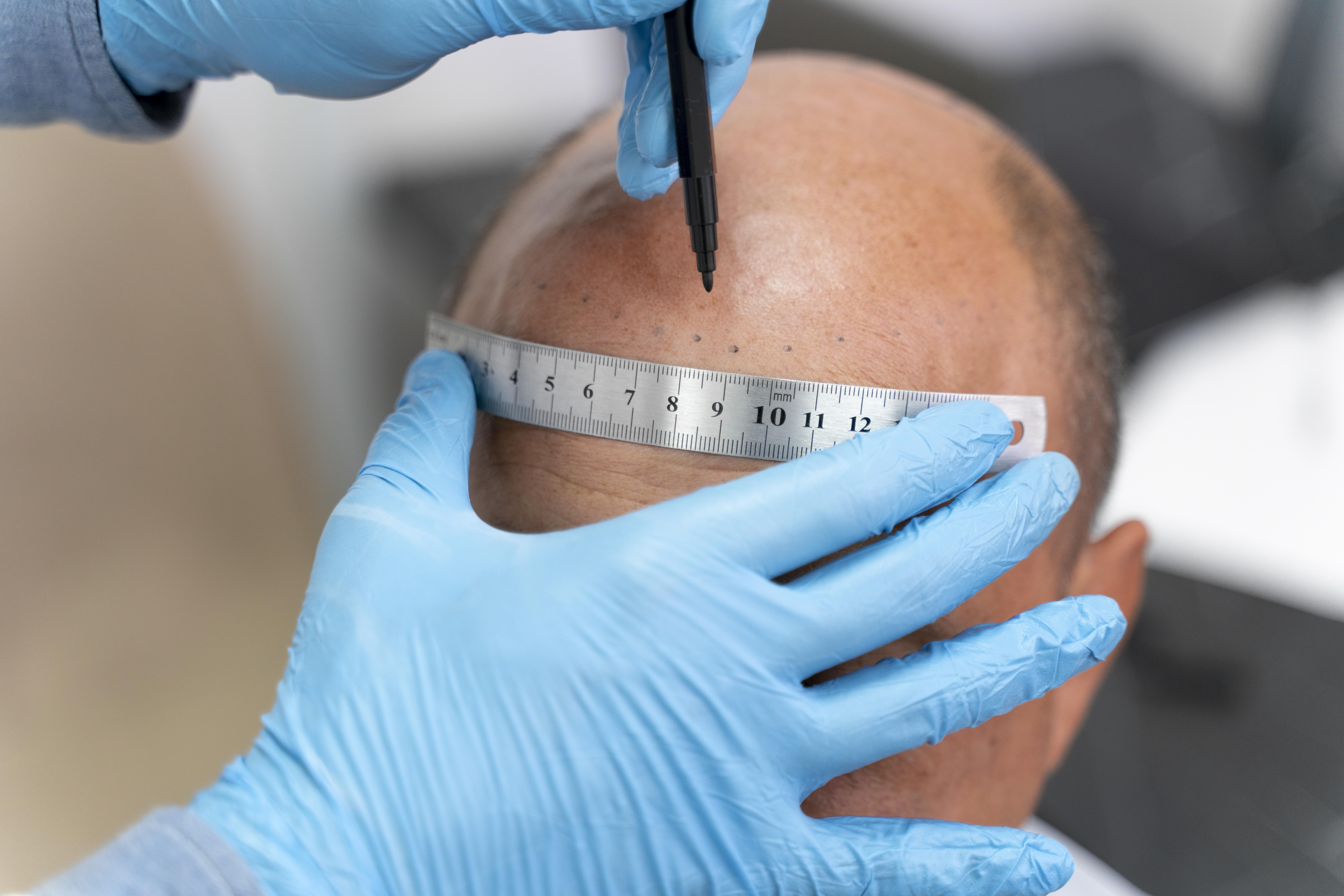 male-going-through-follicular-unit-extraction-process-2 la ligne frontale pour un meilleur rendu esthétique