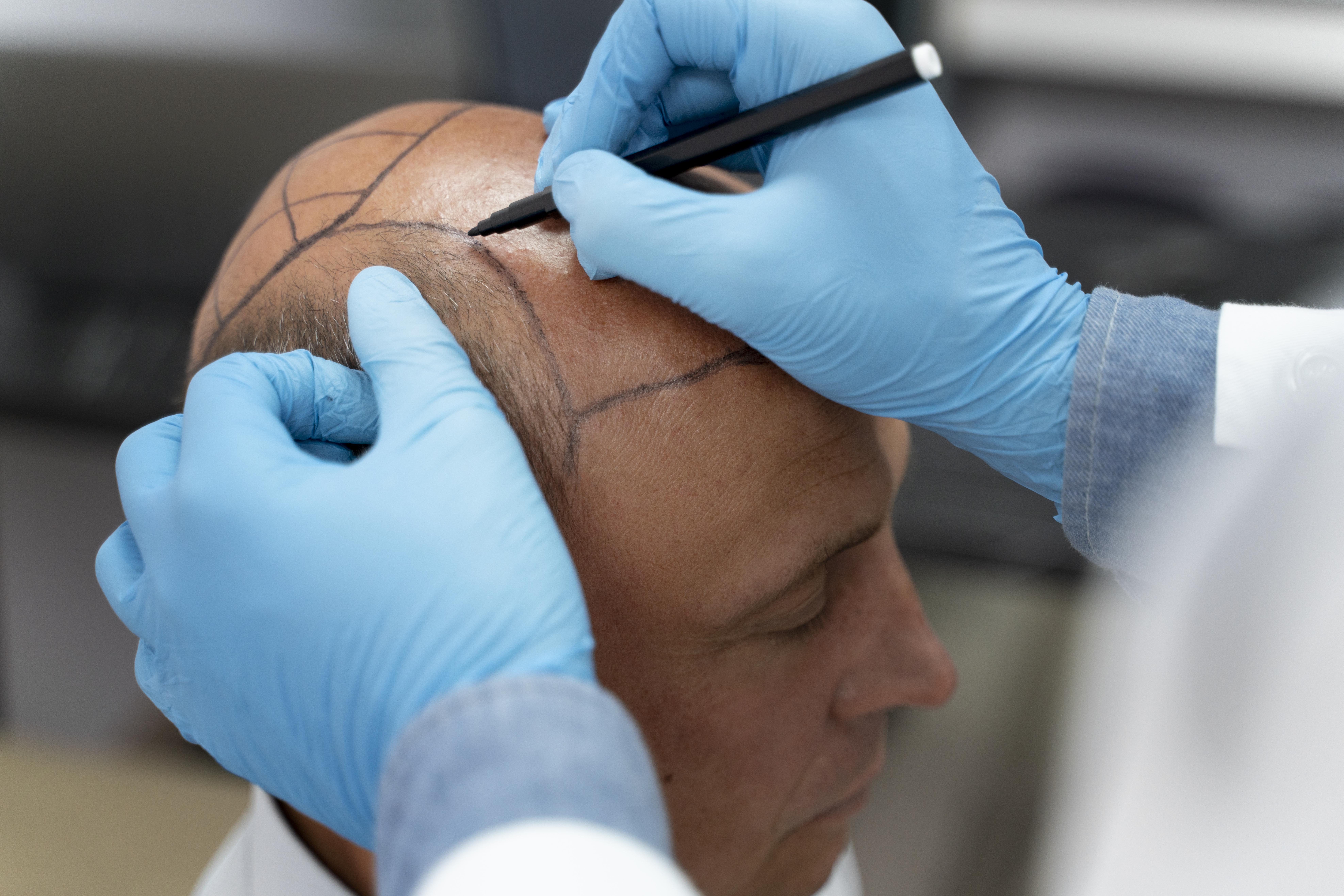 Vous cherchez une solution face à votre chute de cheveux? Vous n'êtes pas prêt à subir une greffe de cheveux? La tricopigmentation capillaire appelée aussi tricopigmentation est une solution sans chirurgie pour dissimuler la chute de cheveux, camoufler votre perte de cheveux durablement avec es résultats hyperréalistes, naturels.