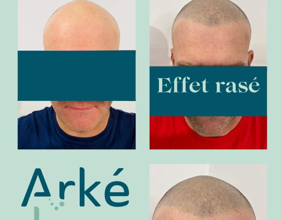 tricopigmentation annecy, dermopigmentation capillaire, restauration capillaire, une solution à la chute de cheveux, une alternative à la greffe de cheveux, fue, fut. effet rasé, effet densité, dissimuler des pelades, des cicatrices du cuir chevelu, c'est possible. Contactez Arkéderm à Annecy pour plus d'informations. venez oublier votre calvitie, votre alopécie.