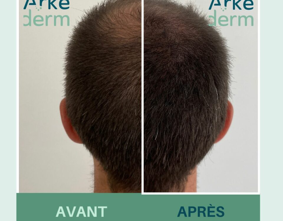 voici un avant après d'une restauration capillaire. Une dermopigmentation capillaire, une tricopigmentation réalisée qui donne l'illusion de densité afin de dissimuler la perte de cheveux pour vous libérer de vos complexes. Le cabinet Arkéderm de tricopigmentation est situé à Annecy à proximité de Genêve, Aix-les-bains, chambéry, grenoble, Lyon.