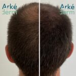 densité, perte de cheveux, alopécie, calvitie tricopigmentation et dermopigmentation capillaire à annecy. une solution à la perte de cheveux. une alternative à la greffe de cheveux appelée aussi scalp micro pigmentation. Le cabinet de tricopigmentation est situé à Annecy à proximité de Genêve, Aix-les-bains, chambéry, grenoble, Lyon. on crée l'illusion de faux cheveux, comme si le follicule pileux repoussait.