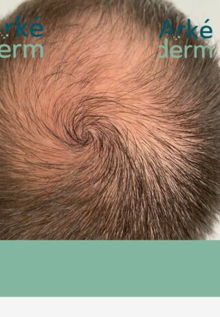 restauration capillaire, manque de densité capillaire, alopécie, calvitie, homme, perte de cheveux nous proposons une solution avec la pigmentation du cuir chevelu. Une alternative à la greffe de cheveux.Le cabinet Arkéderm de tricopigmentation est situé à Annecy à proximité de Genêve, Aix-les-bains, chambéry, grenoble, Lyon. on crée l'illusion de faux cheveux, comme si le follicule pileux repoussait.