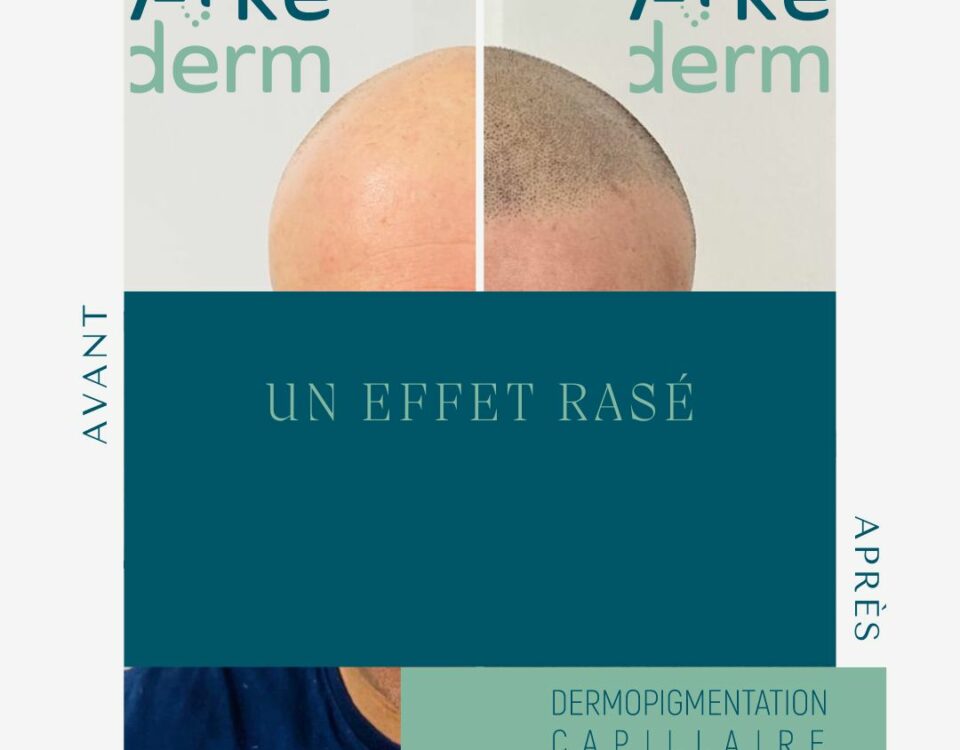 Voici un avant après d'une restauration capillaire. Une dermopigmentation capillaire, une tricopigmentation réalisé qui donne l'illusion de cheveux rasés afin d'homogénéiser votre cuir chevelu et oublier votre calvitie, votre alopécie, votre perte de cheveux. Le cabinet de tricopigmentation est situé à Annecy à proximité de Genêve, Aix-les-bains, Chambéry, Grenoble, Lyon, Jura.