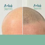 effet rasé sur calvitie trop étendue. La dermopigmentation capillaire appelée aussi tricopigmentation, scalpmicropigmentation. Votre spécialiste vous propose une alternative à la greffe de cheveux à Annecy. Une solution à la perte de cheveux peu connue qui offre des résultats hyperréaliste, durable, réversible. Une technique où l'on crée l'illusion de faux cheveux. Cette méthode est assimilée au maquillage permanent, au tatouage du cuir chevelu pour autant celui-ci est réversible avec des pigments et une technique qui diffère du tatouage.Le cabinet Arkéderm de tricopigmentation est situé à Annecy à proximité de Genêve, Aix-les-bains, Chambéry, grenoble, Lyon, Jura.