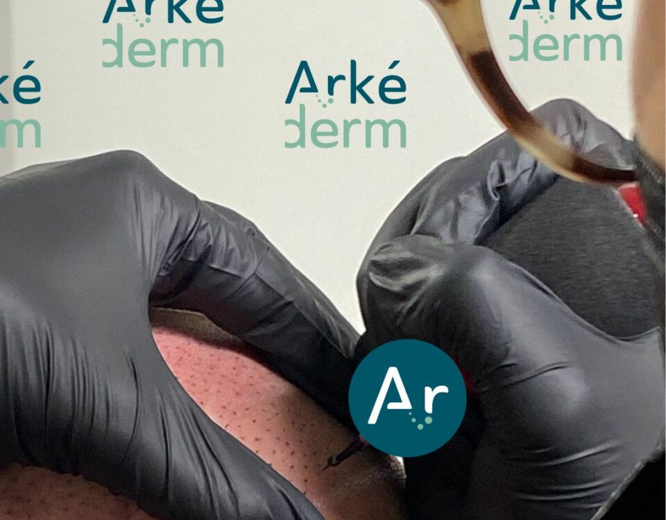 3 séances de dermopigmentation capillaire, de tricopigmentation, de mirco pigmentation capillaire pour vous libérer de votre perte de cheveux. Manque de densité, perte de cheveux, alopécie, calvitie tricopigmentation et dermopigmentation capillaire à annecy. une solution à la perte de cheveux. une alternative à la greffe de cheveux appelée aussi scalp micro pigmentation. Le cabinet de tricopigmentation est situé à Annecy à proximité de Genêve, Aix-les-bains, chambéry, grenoble, Lyon. on crée l'illusion de faux cheveux, comme si le follicule pileux repoussait.