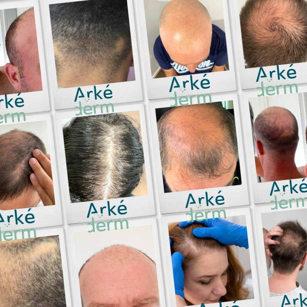 A qui s'adresse la tricopigmentation? cette alternative à la greffe de cheveux est indiquée à toute personne qui ont une calvitie, une alopécie androgénétique, une pelade, une cicatrice du cuir chevelu, des cicatrices post greffes, implants capillaire fue, fut à camoufler... Le cabinet Arkéderm de tricopigmentation est situé à Annecy à proximité de Genêve, Aix-les-bains, Chambéry, grenoble, Lyon, Jura.