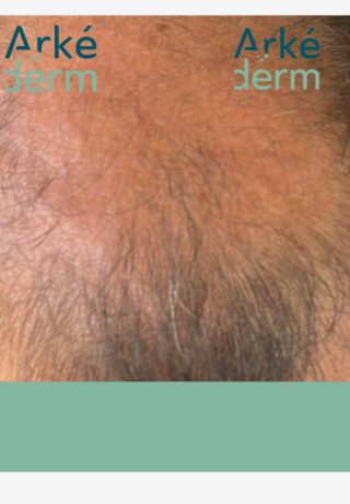 calvitie, alopécie diffuse, besoin d'une restauration capillaire, Arkéderm propose une alternative à la greffe de cheveux avec la tricopigmentation appelée aussi dermopigmentation capillaire, scalp micropigmentation: un effet de cheveux rasés ou un effet de densification capillaire.