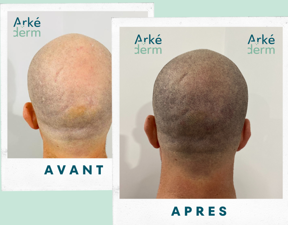 tricopigmentation annecy, dermopigmentation capillaire, restauration capillaire, une solution à la chute de cheveux, une alternative à la greffe de cheveux, fue, fut. effet rasé, effet densité, dissimuler des pelades, des cicatrices du cuir chevelu, c'est possible. Contactez Arkéderm à Annecy pour plus d'informations. Venez oublier votre calvitie, votre alopécie.