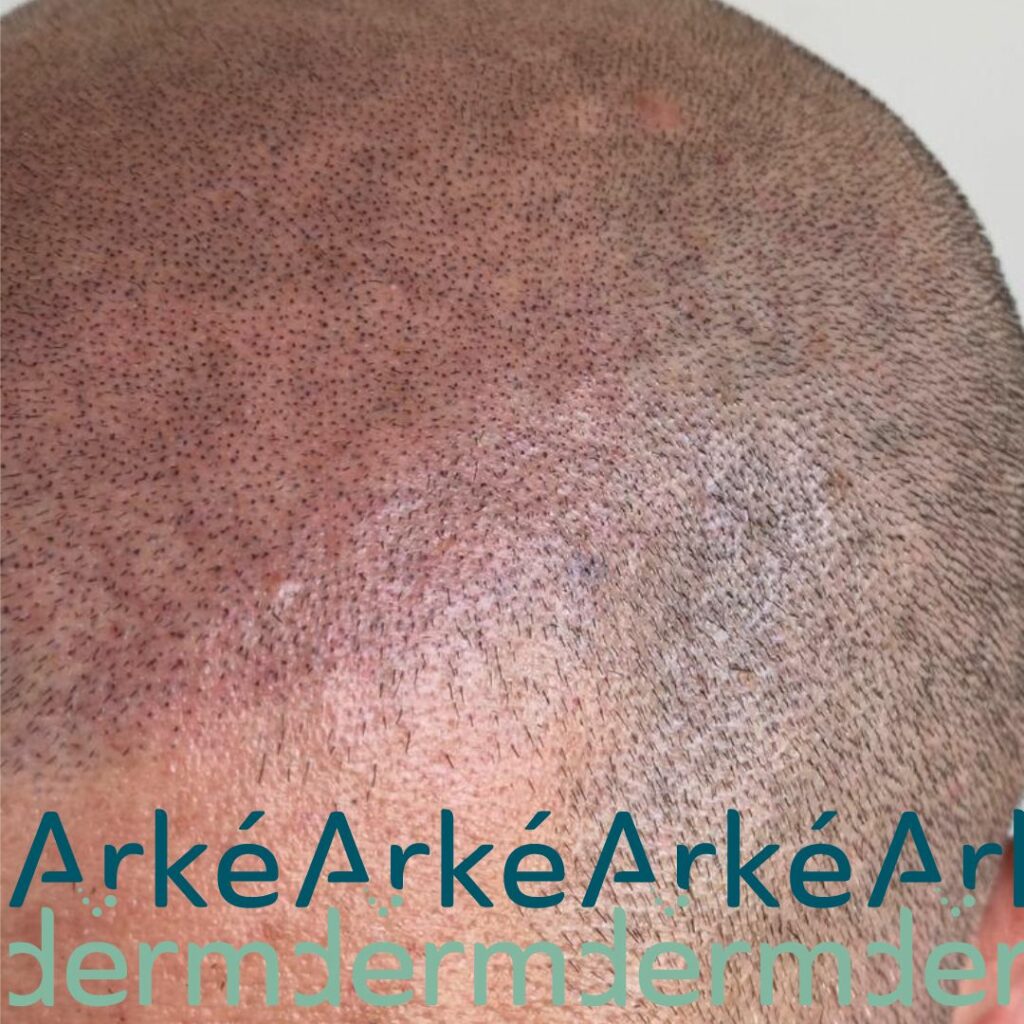 un effet rasé réalisé par Arkéderm, votre spécialiste de la dermopigmentation capillaire situé à Annecy. Cette technique est aussi appelé tricopigmentation, micro pigmentation capillaire, scalp micropigmentation. Elle a pour objectif de réaliser une restauration capillaire lorsque l'on perd ses cheveux, que l'on subit la calvitie, l'alopécie, des pelades ou que l'on veut compléter une greffe de cheveux, ou trouver une alternative à la greffe capillaire. Le cabinet Arkéderm de tricopigmentation est situé à Annecy à proximité de Genêve, Aix-les-bains, chambéry, grenoble, Lyon. on crée l'illusion de faux cheveux, comme si le follicule pileux repoussait.