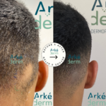 pelade cicatrices cheveux annecy solution perte de cheveux proche de Lyon Genève