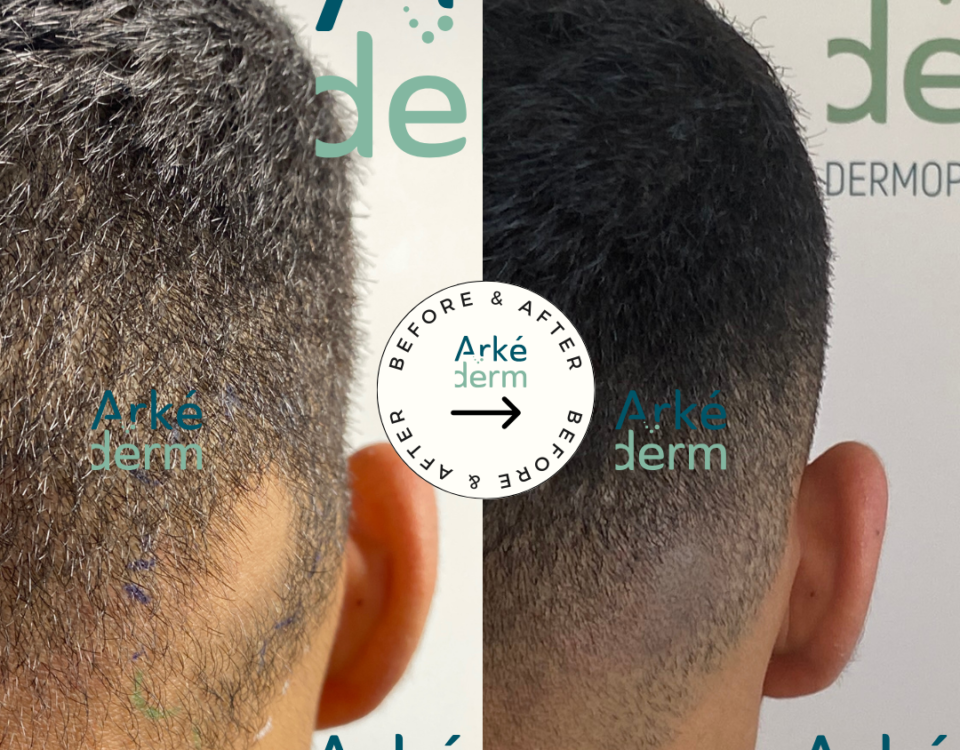 pelade cicatrices cheveux annecy solution perte de cheveux proche de Lyon Genève